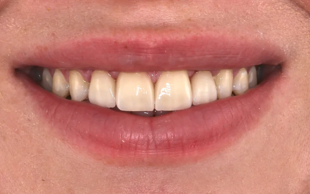 After: a brighter, balanced smile with even proportions