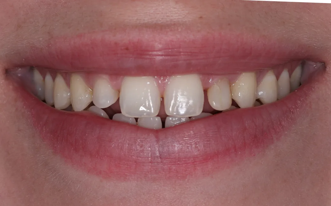 Before: a smile with narrow side teeth and a dulled shade