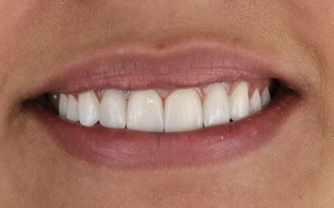 Después: una sonrisa alineada, más brillante y más llena