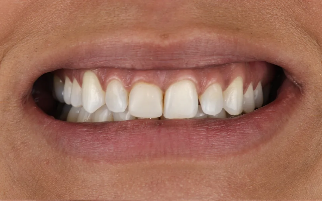 Antes: proporciones desiguales y una línea de sonrisa retraída