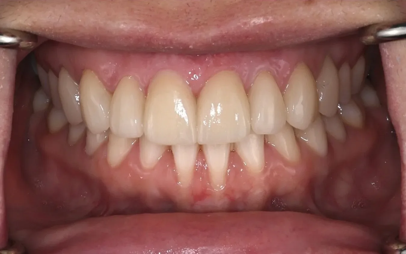 After: the gap between the front teeth closed, retracted clinical view
