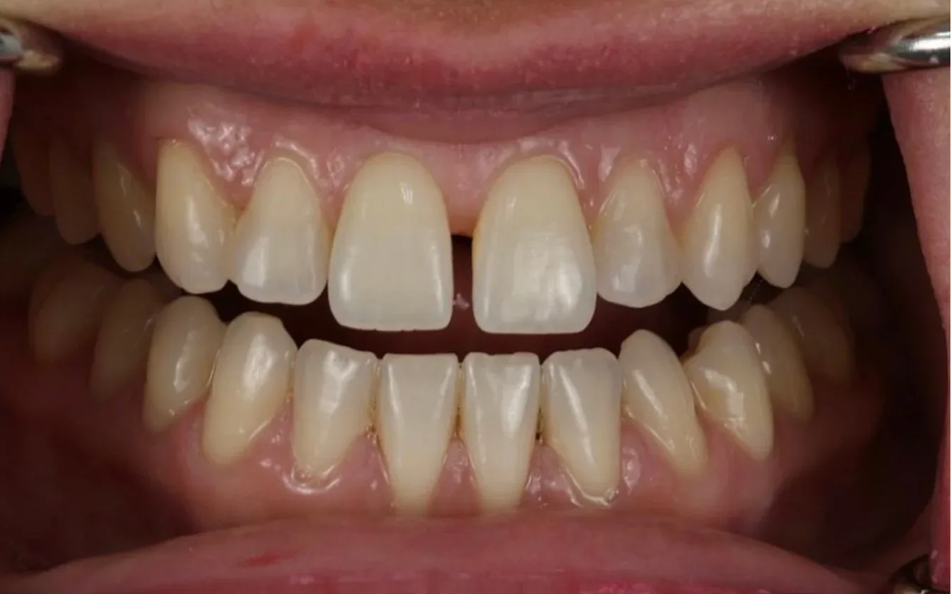 Before: a visible gap between the two front teeth, retracted clinical view