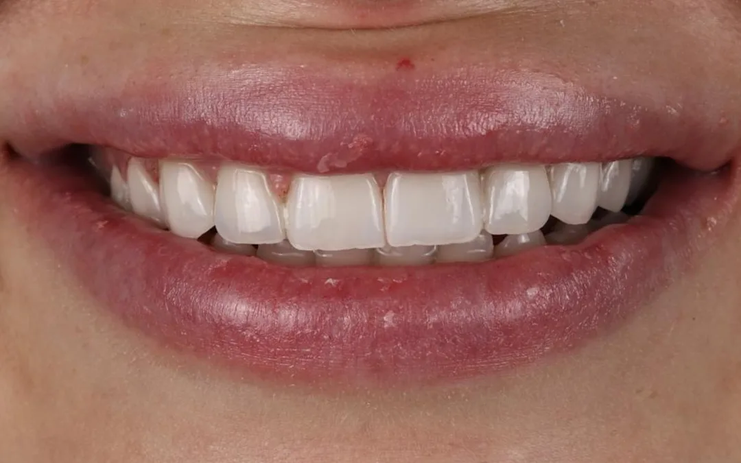 After: rebuilt, even front teeth with a natural shade