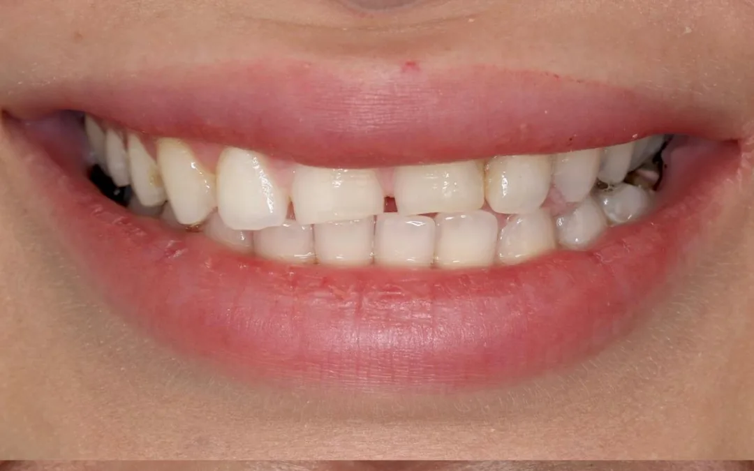 Before: worn, uneven front teeth with irregular edges
