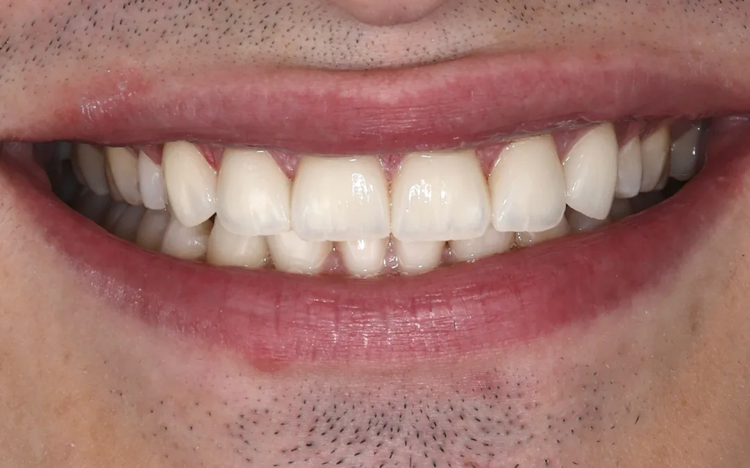 After: a complete, even smile with chips and gaps restored