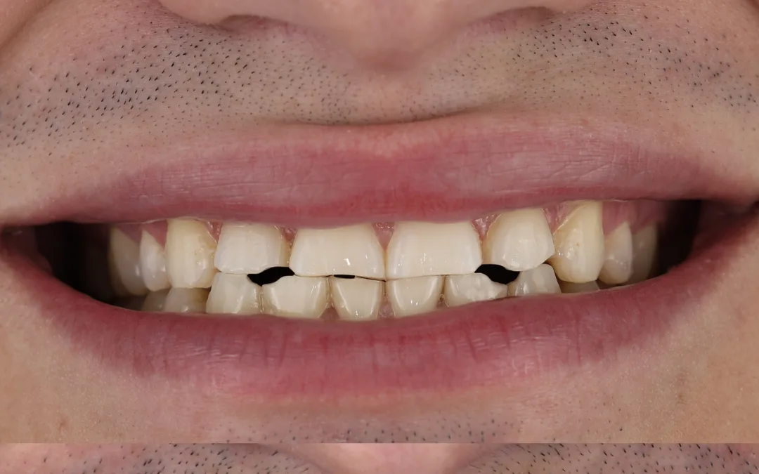 Before: chipped front teeth with visible dark gaps
