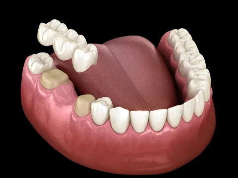 A three-dimensional model of a lower jaw with a bridge being seated over prepared teeth