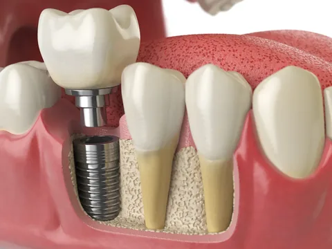 A cutaway view of a titanium implant anchored in the jawbone beneath a crown