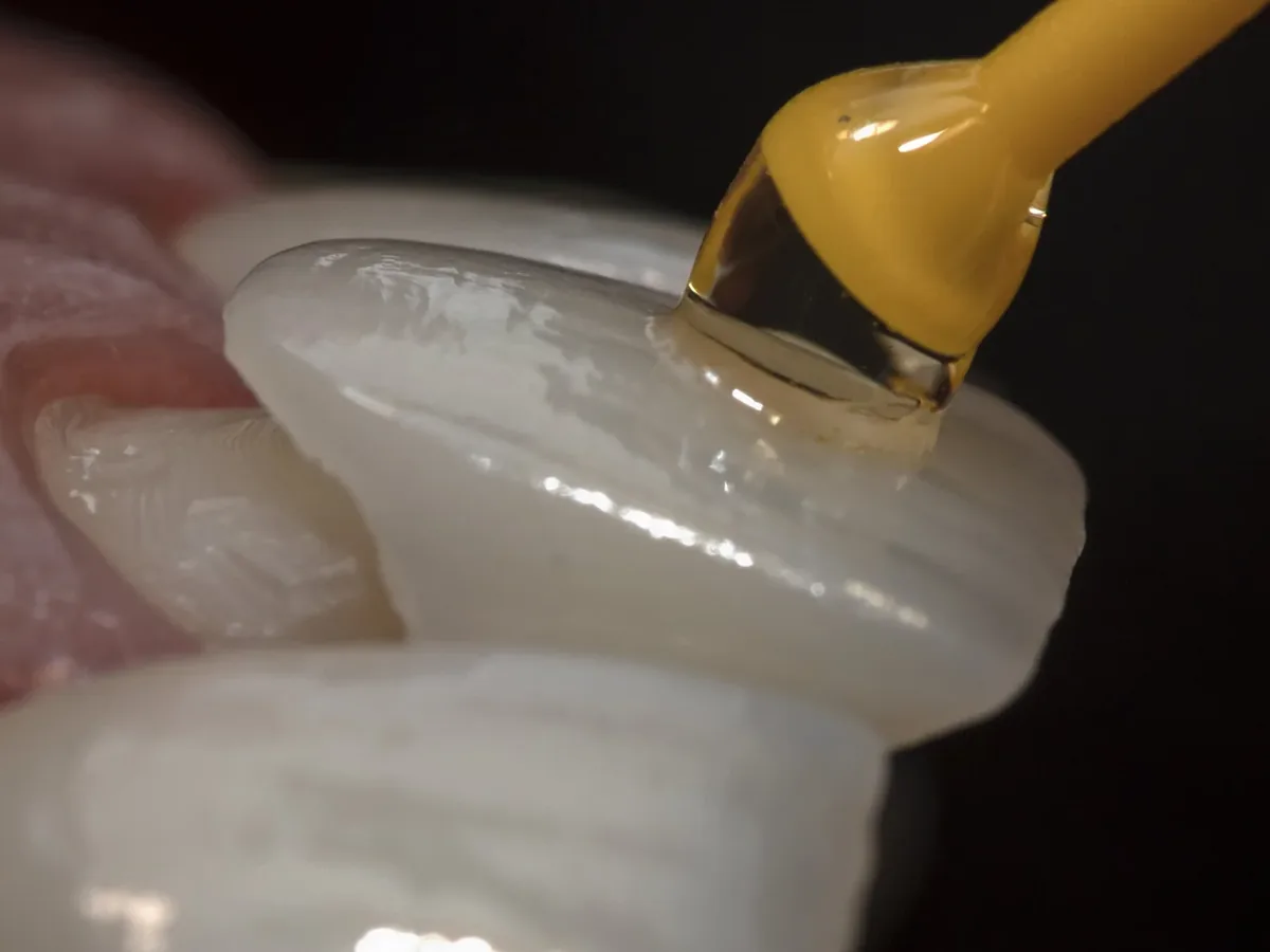 A thin porcelain veneer being placed onto a prepared front tooth with a bonding instrument