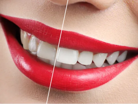 A close-up smile divided down the middle, comparing tooth shade before and after whitening